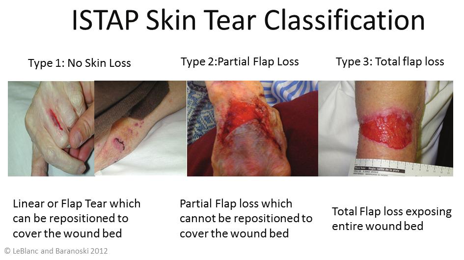 Adaptação cultural e validade de conteúdo do ISTAP Skin Tear Classification para o português no Brasil à anterior, laceração ou ferida traumática, considerada mais genérica.