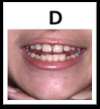 língua atrás dos dentes de