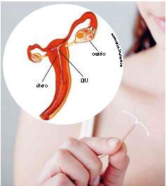 Dispositivo intrauterino (DIU) Trata-se de uma pequena peça de plástico recoberta de cobre, colocada no útero pelo médico.