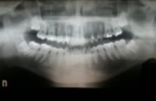 dentes 35 e 36, sem alteração dos tecidos moles adjacentes e não apresentava nenhum tipo de sintomatologia e/ou crepitação à palpação.