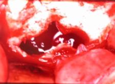 6) e, um ano após, o procedimento não apresentava imagem de lesão radiolúcida (FIG. 7). Figura 2 - Cortical óssea adelgaçada próximo ao nervo mentoniano.