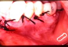 000), com bloqueio dos nervos alveolar inferior, lingual e bucal. Incisão intrabucal foi realizada.