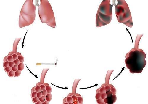 Enfisema Irritação respiratória crônica; Os alvéolos transformam-se em bolsas de ar que dificultam o contato do ar com o sangue (destruição do