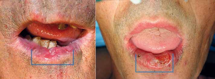 INTRODUÇÃO O carcinoma espinhocelular é a neoplasia maligna mais frequente dos lábios, localizando-se no lábio inferior em cerca de 90% dos casos, em virtude da maior exposição cumulativa à radiação