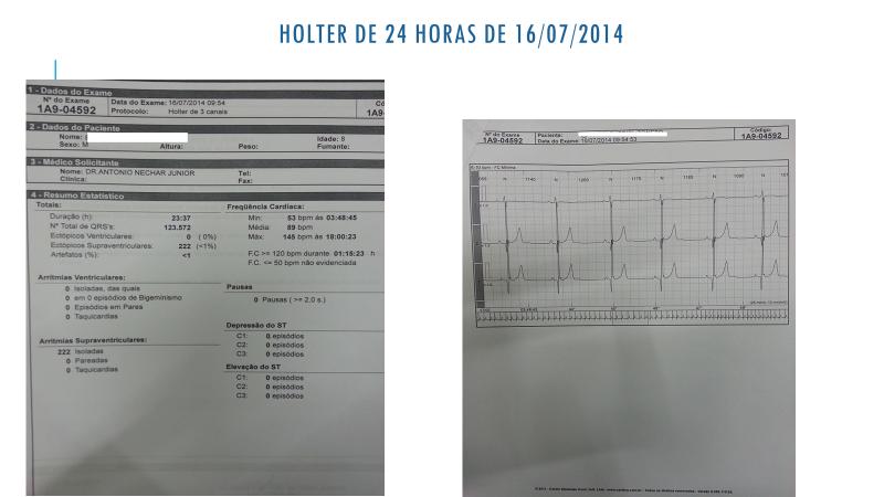 36 Rosana M.C. Nechar & Antônio Nechar Jr. antiarrítmico, até a suspensão do mesmo em 2013. Na avaliação de julho de 2014 (Fig.