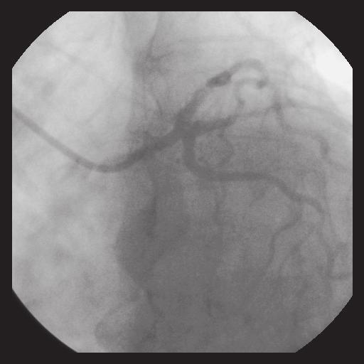 e sem dissecção (Figura 4). Paciente estável, assintomático, recebeu alta hospitalar três dias após a angioplastia.