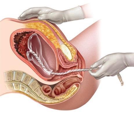 Parto e Aleitamento O parto ocorre geralmente em três fases: Expulsão da placenta Acontece 5 a 15 minutos após a