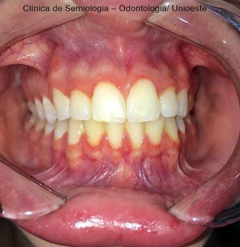 Avaliação intraoral: Exame radiográfico (panorâmica):