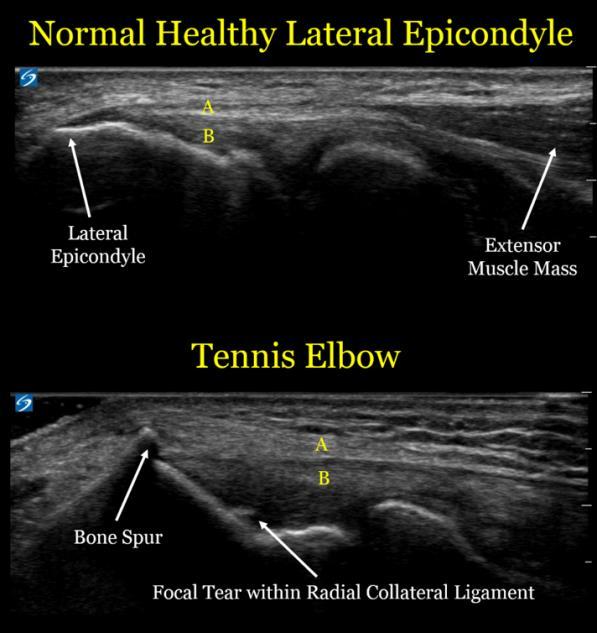 Sintomatologia A epicondilite lateral começa como uma microruptura da origem do músculo extensor radial curto do carpo, mas pode envolver o extensor radial longo e o extensor ulnar do carpo.