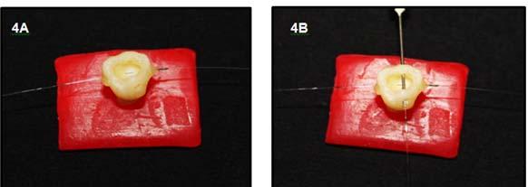 (A) Cavidade Classe I (4x4x4mm); (B) Cavidade vestíbulo-lingual com ponta diamantada #1013 AR Figura 4 - Posicionamento do Sensor de Fibra Ótica: (A) Sensor de fibra ótica