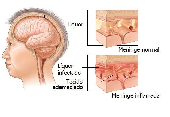 Esclerose Múltipla Doença