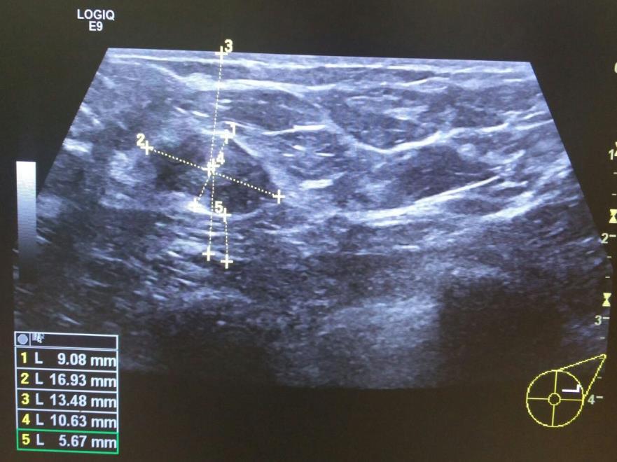 BLES Técnica Identificação de lesão mamária com