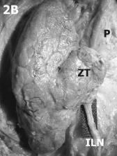 tireoideana inferior Relação com o polo inferior da tireóide Tubérculo de Zuckerkandl projeção látero-posterior da porção lateral dos