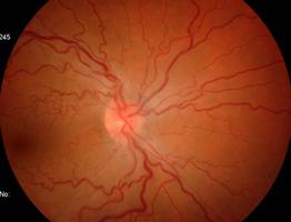 4 Vaso sanguíneo congénito macular (OCT) Tortuosidade arteriolar retiniana familiar