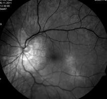 Fig. 2.34 Hipoplasia unilateral nervo óptico Fig. 2.35 Hipoplasia unilateral nervo óptico Fig.