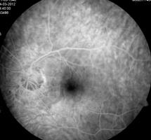 37 Hipoplasia unilateral nervo óptico (AF) Outras patologias: