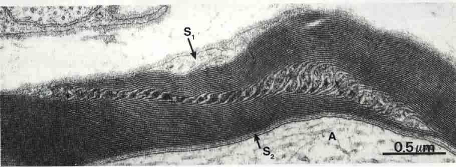 INCISURA DE