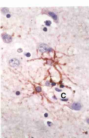 ASTRÓCITOS FIBROSOS Localizados na substância