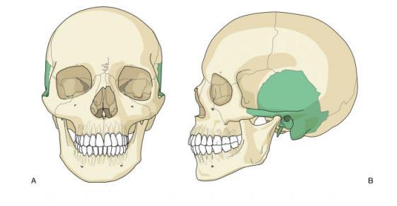 Figura 2.3 Localização dos ossos temporais. Vista anterior (A) e vista lateral (B) [8]. Figura 2.4 - Osso temporal, vista lateral. Adaptado de [6]. 2.1.
