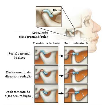 Figura 3.1 - Deslocamentos discais. Adaptado de [22]. 3.1.1.1 Deslocamento do disco com redução O deslocamento do disco com redução é o tipo mais comum de deslocamento discal [20].