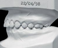 Figueiredo, M. A.; Siqueira, D. F.; Bommarito, S.; Scanavini, M. A. FIGURA 33, 34, 35 - Modelos de estudo do final do tratamento.