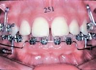 Desta maneira pode-se concluir que o uso dos elásticos de Classe II não teve um efeito indesejado de extrusão dos primeiros molares inferiores durante o tratamento ortodôntico.