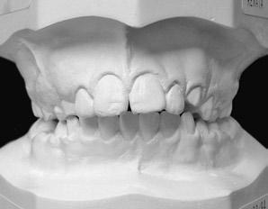 Os braquetes nos dentes superiores não foram colados até que a correção ortopédica com a utilização do arco extrabucal tivesse sido realizada.