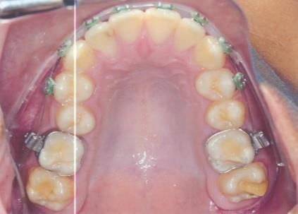 Figura 2(A-E)- Fotografias intrabucais iniciais: A) Intra bucal lateral direita; B)