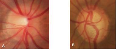 Figura 2. (A) Normal, (B) Glaucoma and suspicious de extração de características. Então com a imagem original foram testados os esquemas de cores RGB, Lab e YCrCb.