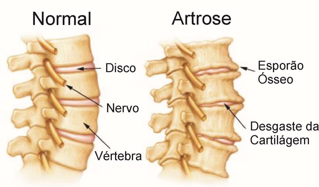 Artrose Não