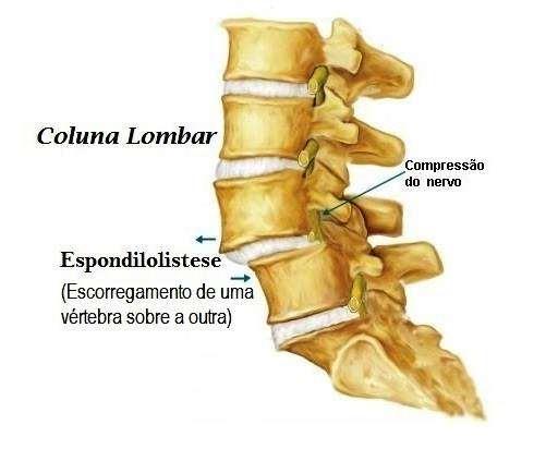 Espondilolistese Devemos tomar cuidado com massagens