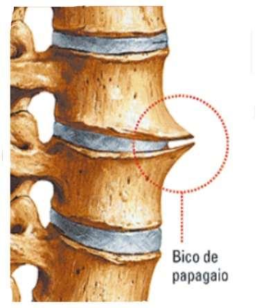Osteofitos Neste caso a massagem é muito eficaz, pois ao massagearmos os musculos serão relaxados e
