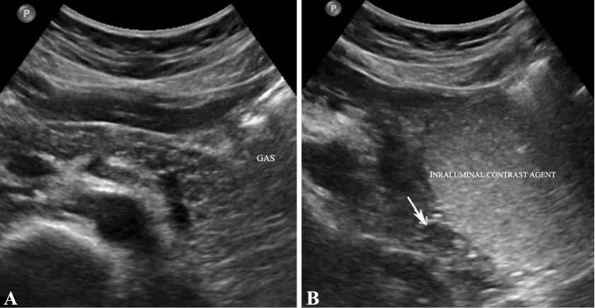 Caso 3 - Tumor de células de ilhéus pancreáticos (insulinoma) em mulher de 37 anos A cauda pancreática não foi visualizada na ecografia