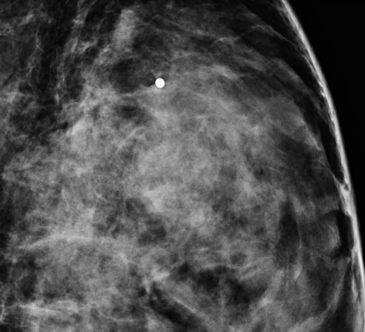 Tumor desmóide da mama Mais comum em mulheres jovens, sem potencial