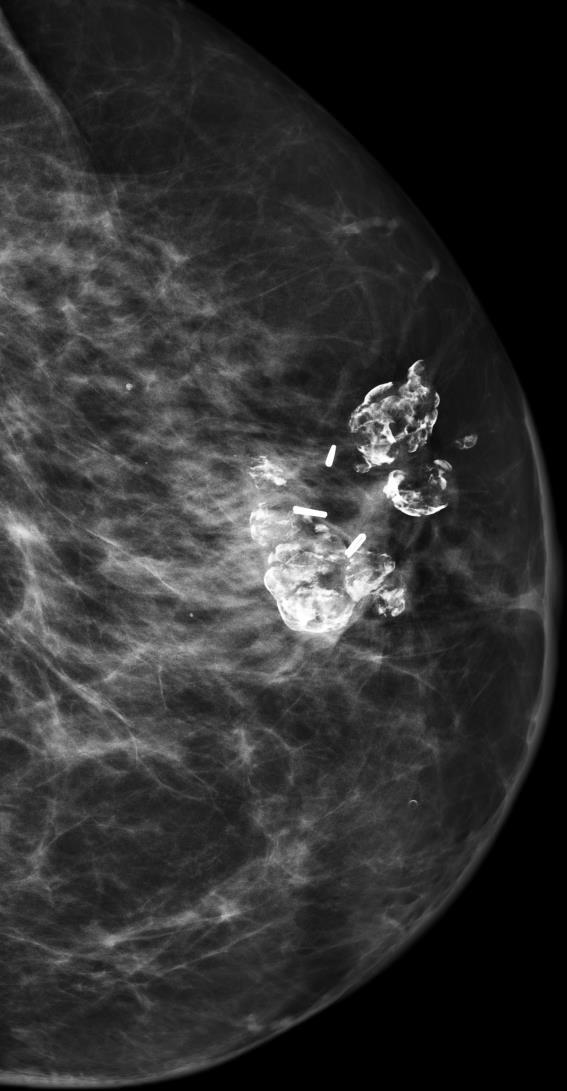 Citoesteatonecrose Amplo especto de apresentações em mamografia mas