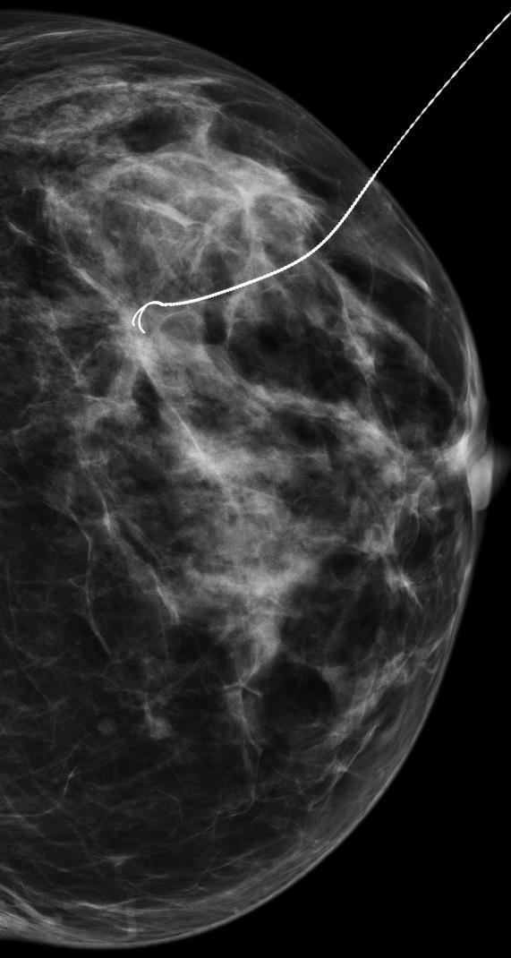 Cicatriz radiária Tem aspecto espiculado em mamografia mas apresenta características mamográficas típicas, permitindo a distinção com carcinoma: Aspecto