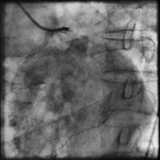 miocárdio que mostrou isquemia extensa na parede anterior Caso clínico adaptado da prática
