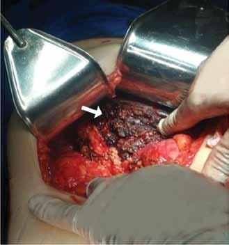 Hemi-HePateCtomia Para CiStoadenoma biliar incisão subcostal direita que a paciente apresentava por motivo de uma colecistectomia aberta.
