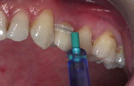 motivação, higiene oral e saúde peri-implantar. As consultas podem ser feitas a cada 3 a 6 meses, ou uma vez por ano.