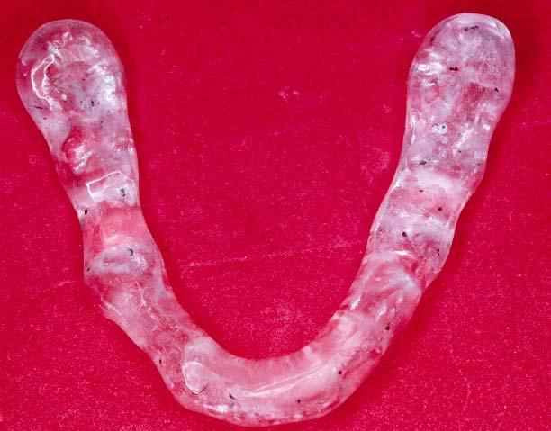 Material e Método 83 modelo mandibular foi realizada através da confecção de um guia de Lucia, que mantinha os dentes separados em aproximadamente 3mm.