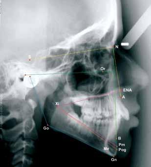 mandibular - distância entre o ponto Co-Go; Os pontos estão demonstrados na figura 4 e as