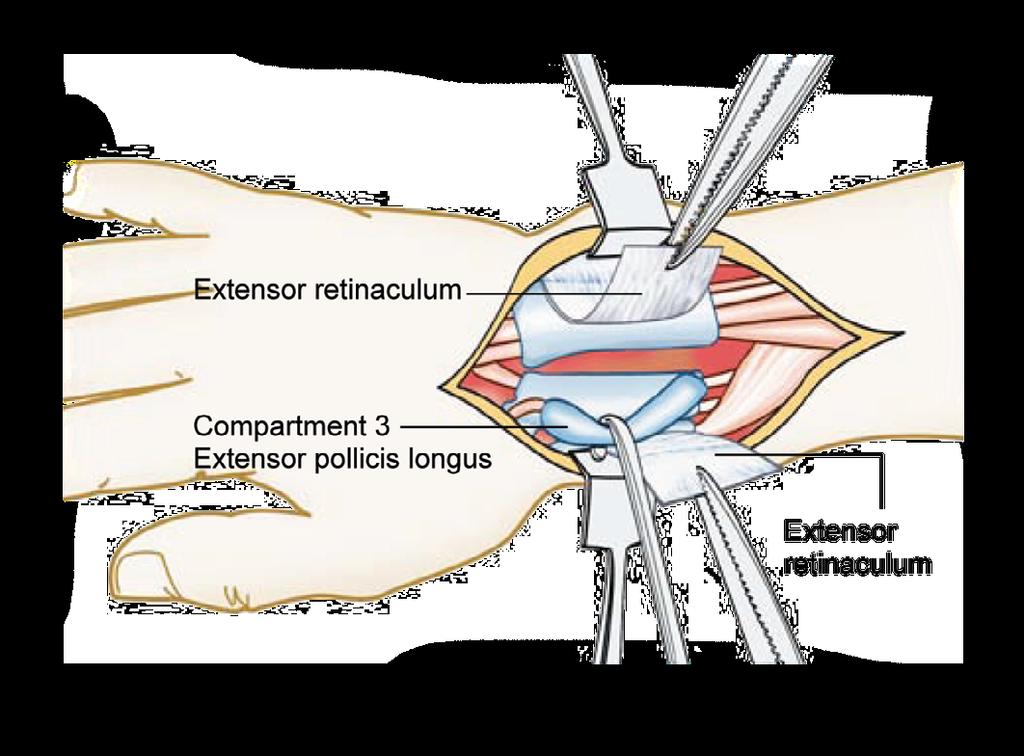 ventre muscular do compartimento do primeiro extensor.