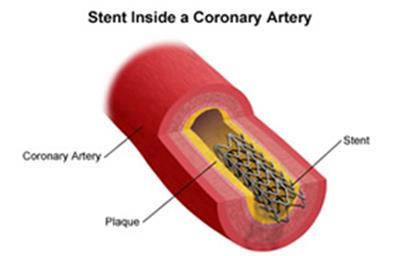 Projeto Stents Processos Levantamento de volumetria e valores praticados no Polo Mercosul; Aproximação com a Indústria;