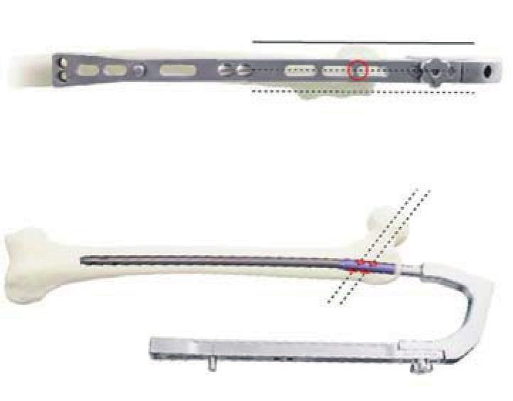 MODO RECON Parafusos de 6.3 mm devem ser utilizados no colo femoral para o modo de reconstrução (recon). Monte a haste e o cabo introdutor da haste (899499) usando o parafuso de conexão (899500).