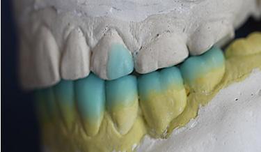 dentes posteriores bilateral.