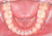 o atingir o centro de resistência (R) do dente, esse realiza um movimento de translação.