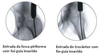 Haste da fossa piriforme Se utilizar a haste da fossa piriforme, o ponto de acesso é entre o topo do pescoço femoral e a base da fossa piriforme.