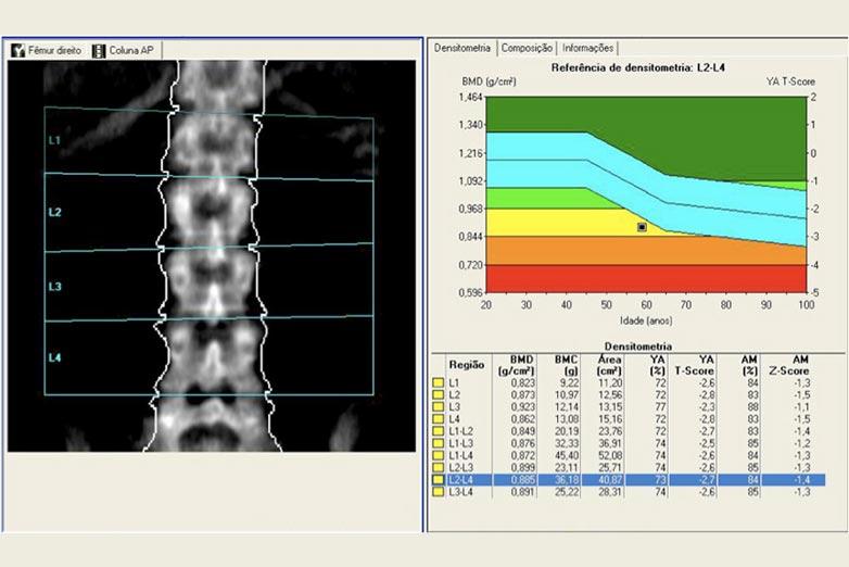 Densitometria óssea g/cm 2 Comparação com indivídos jovens Gia o tratamento
