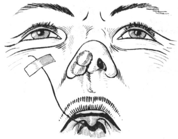 Anestesia tópica Sonda naso-oral Ancoragem do