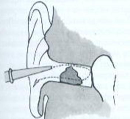 cerume firme ou amolecido Acúmulo do cerume